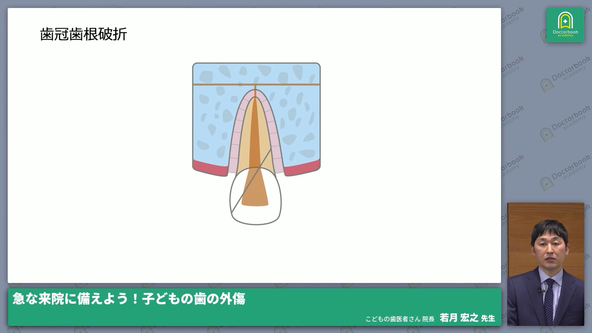  臨床知見録_小児の外傷_歯冠歯根破折