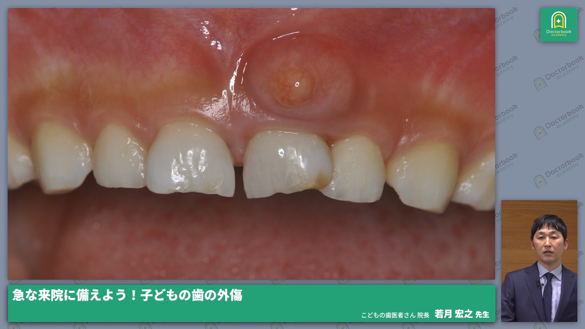  臨床知見録_小児の外傷_予後説明②（アブセス・サイナストラクト）