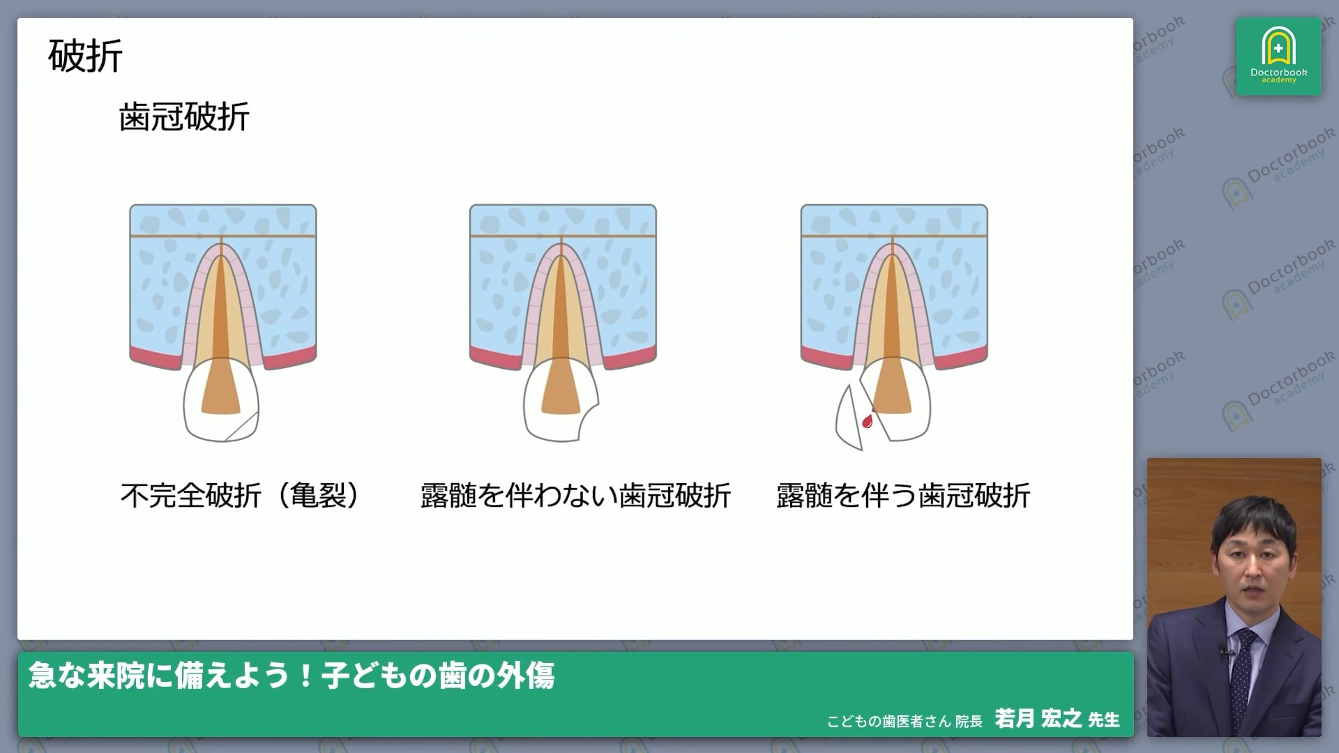  臨床知見録_小児の外傷_露髄を伴わない歯冠破折