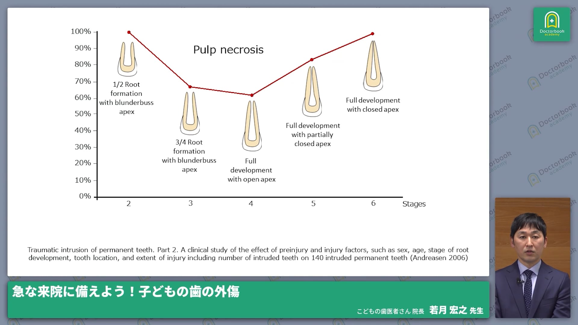  臨床知見録_小児の外傷_根の完成度と歯髄壊死を起こす確率の研究