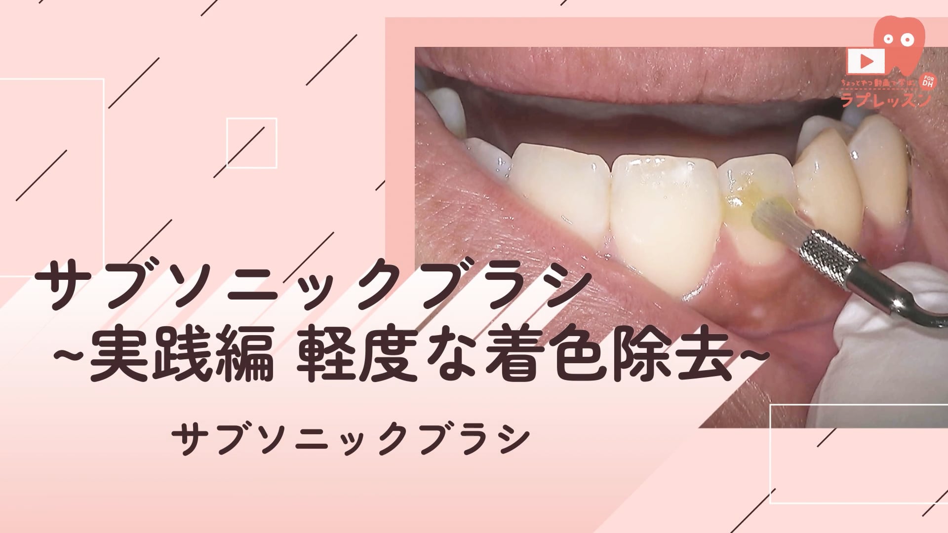 06.サブソニックブラシ ~実践編 軽度な着色除去~