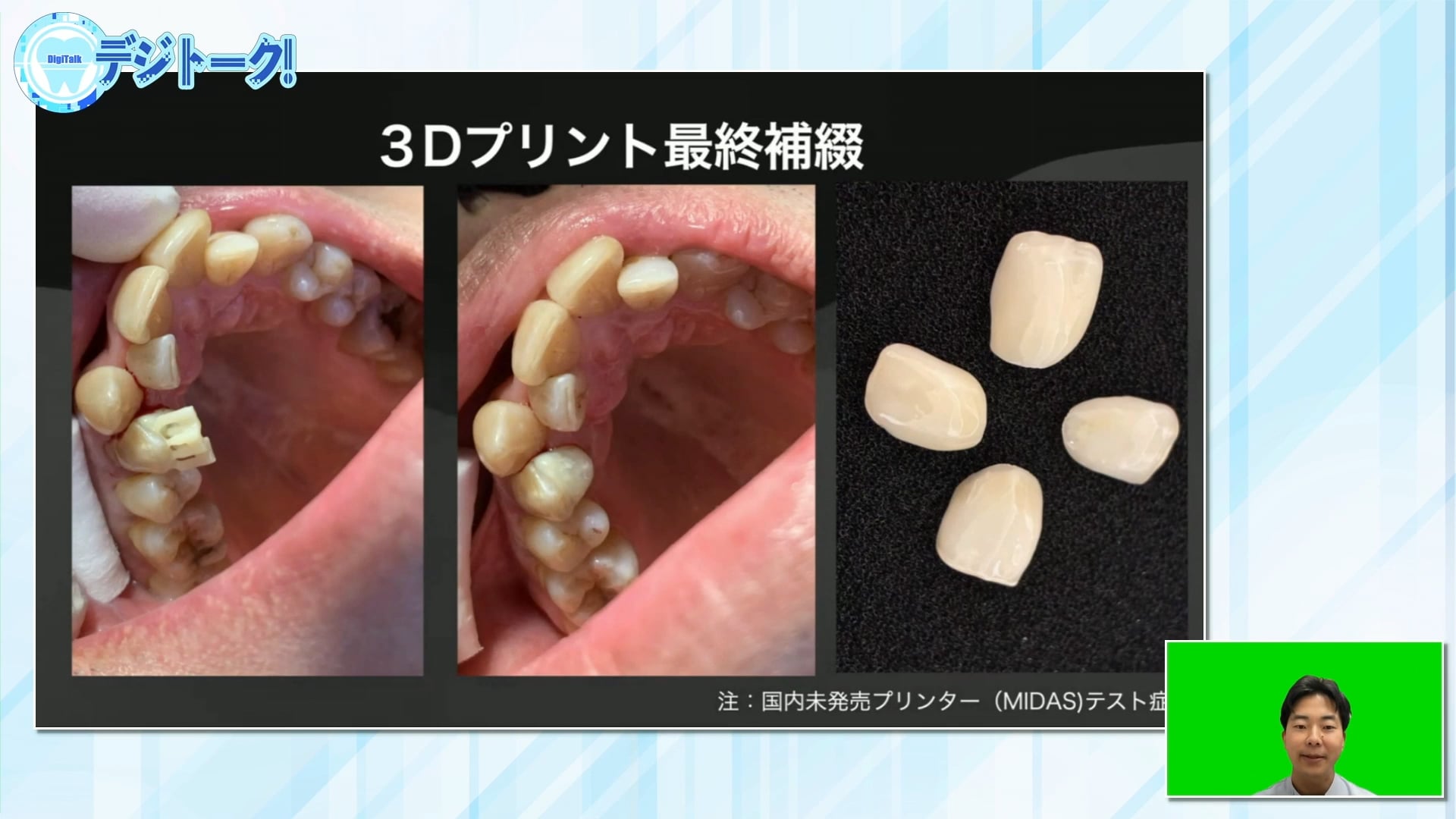 3Dプリンターを用いたパーマネントクラウンの作成方法