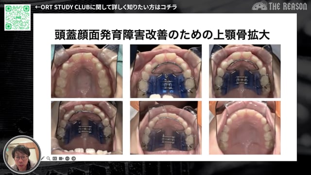 第34回 8歳女児の小児矯正症例：口呼吸・アレルギーと成長期介入の実際