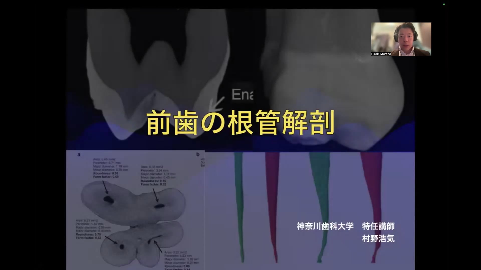前歯の根管解剖｜村野浩気先生(Essentials)