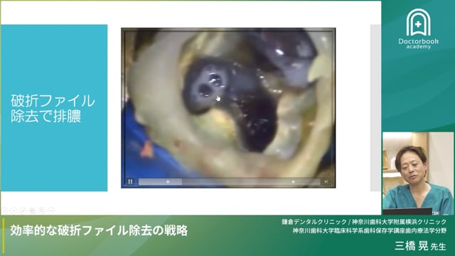 効率的な破折ファイル除去の戦略