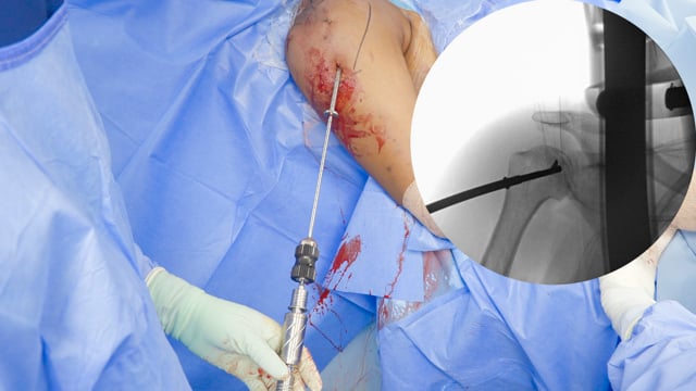 Humeral Head Core Decompression for Treatment of Avascular Necrosis