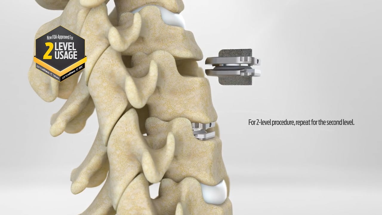 Centinel Spine Videos - prodisc C SK Surgical Technique with prodisc ...