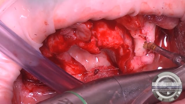 Guided Pterygoid Implant Success 80ncm/80ncm