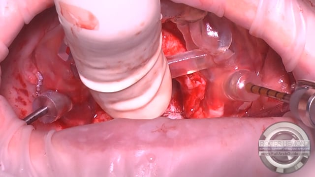 Guided Pterygoid Implant Success 80ncm/80ncm