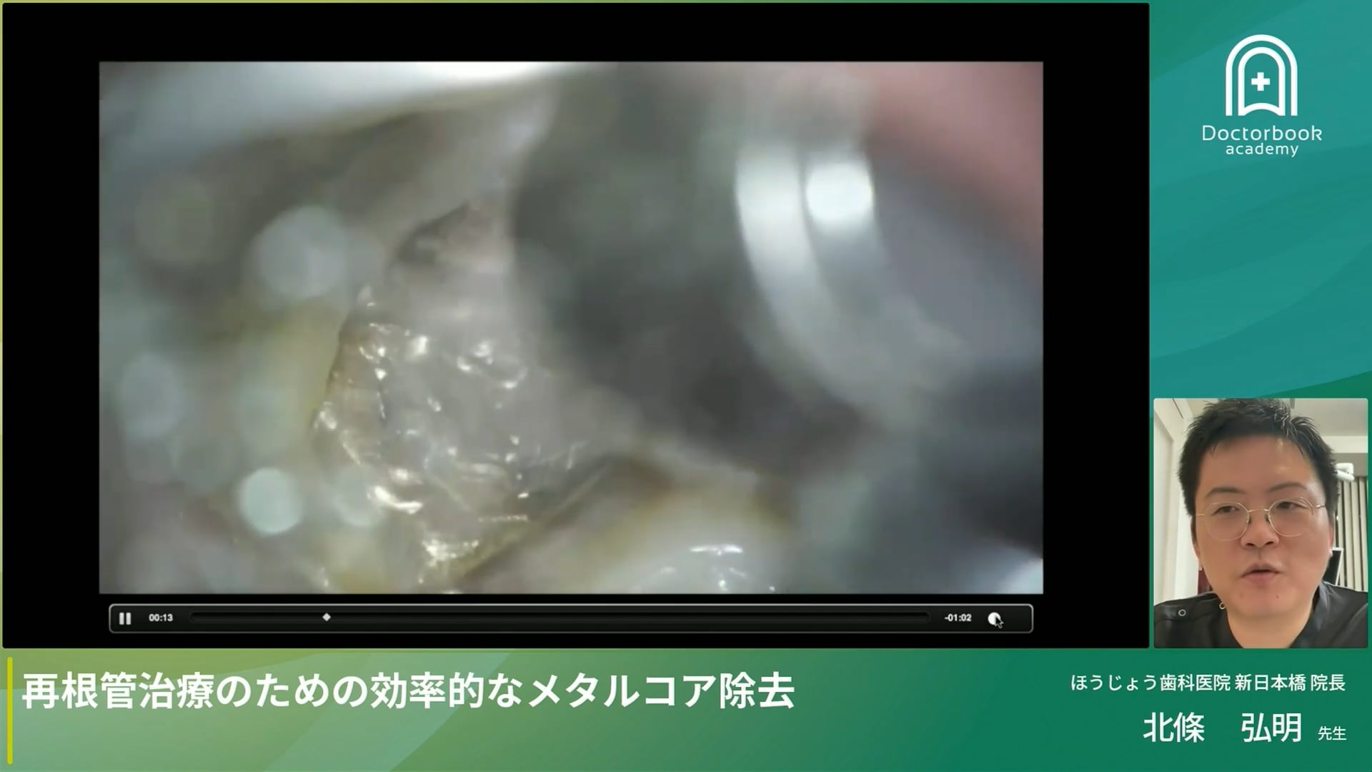 再根管治療のための効率的なメタルコア除去