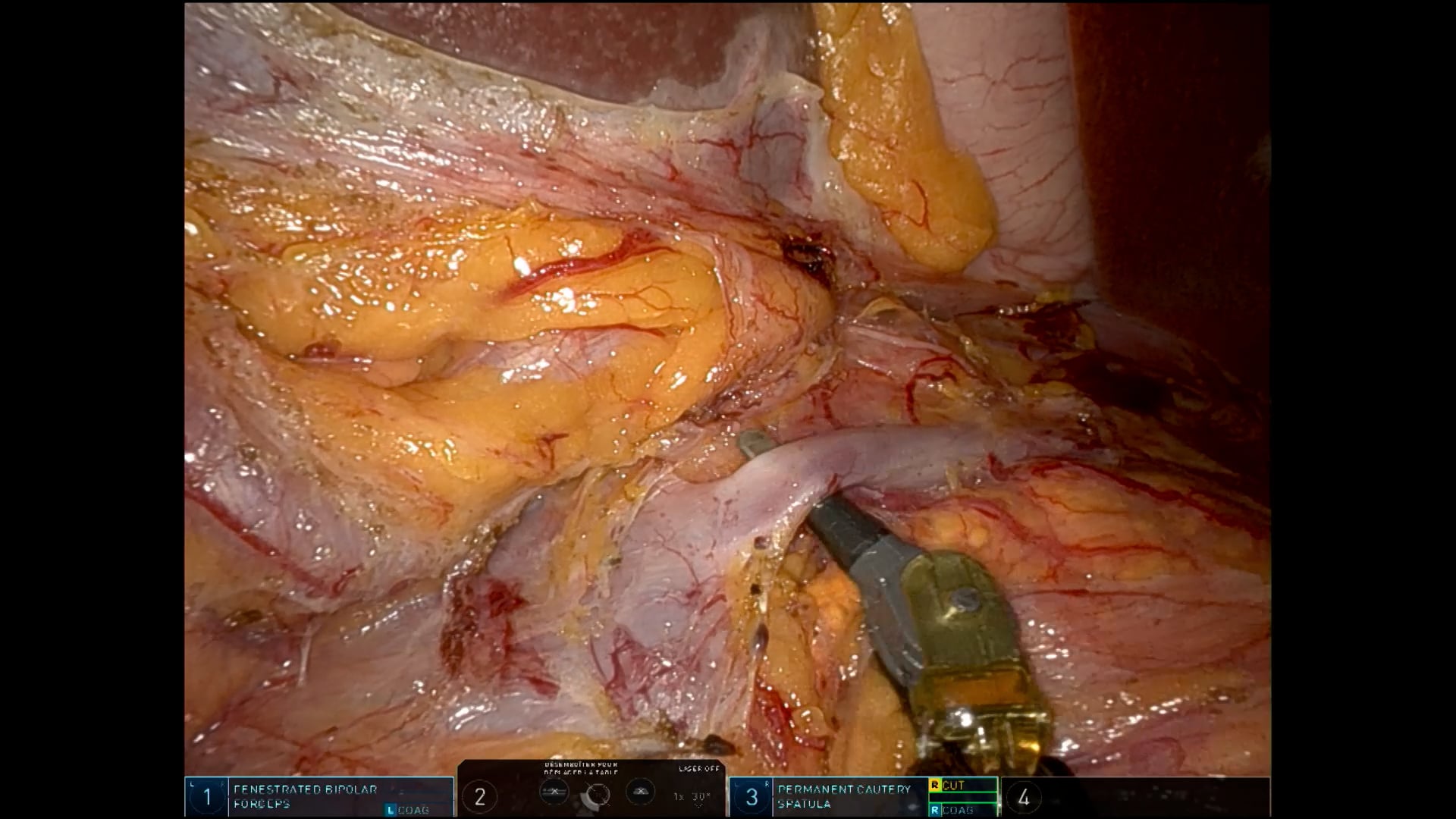 Laparoscopic and robot-assisted left adrenalectomy in a female patient with primary hyperaldosteronism 