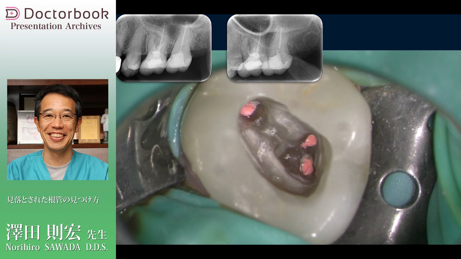 見落とされた根管の見つけ方