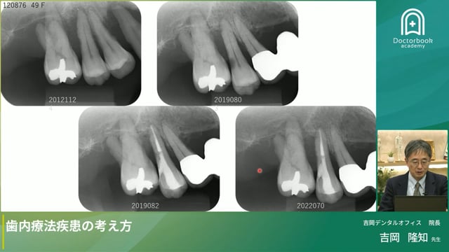 歯内療法疾患の考え方