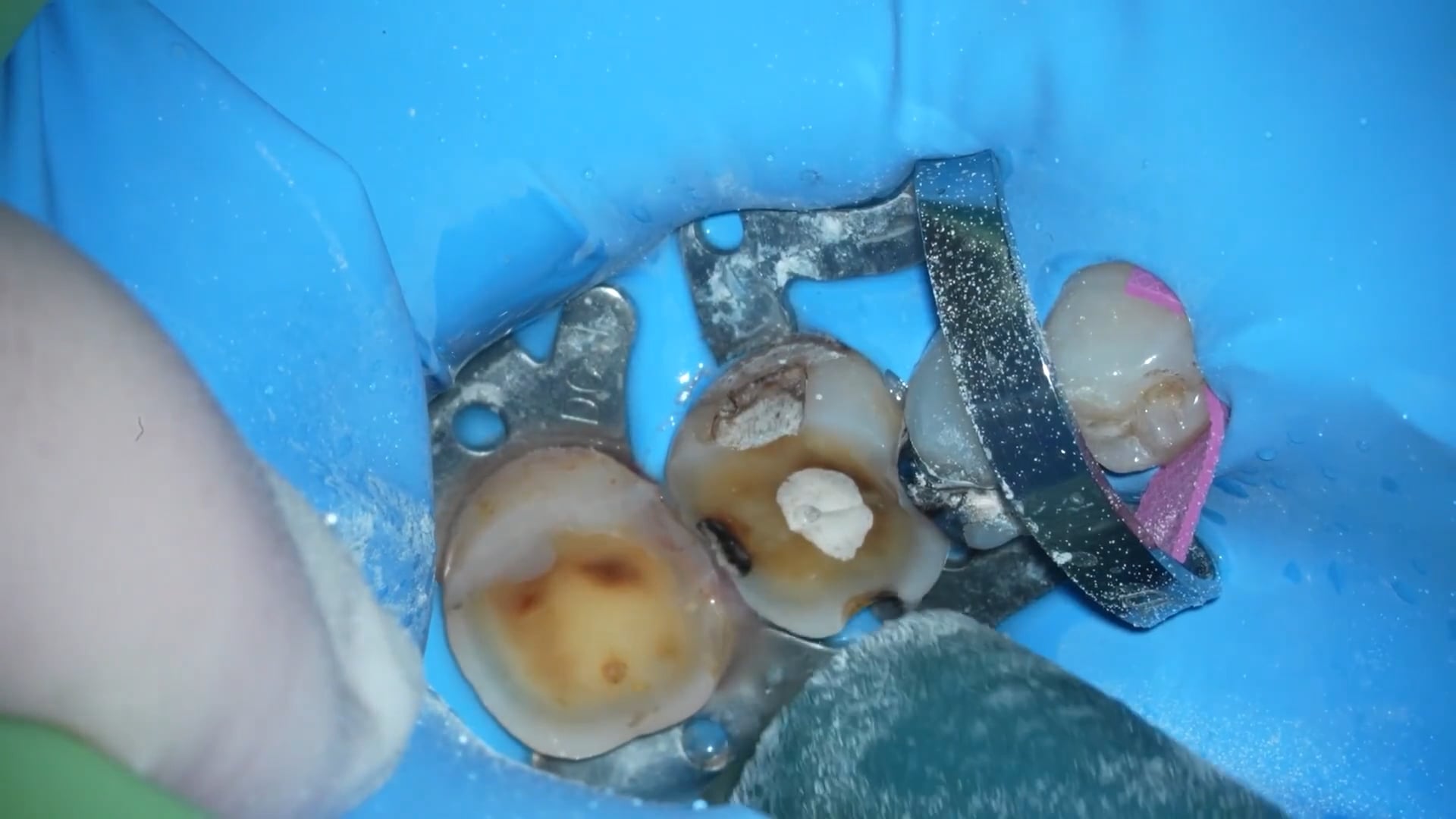 【GPB_crown_llp_040】う蝕除去+形成①