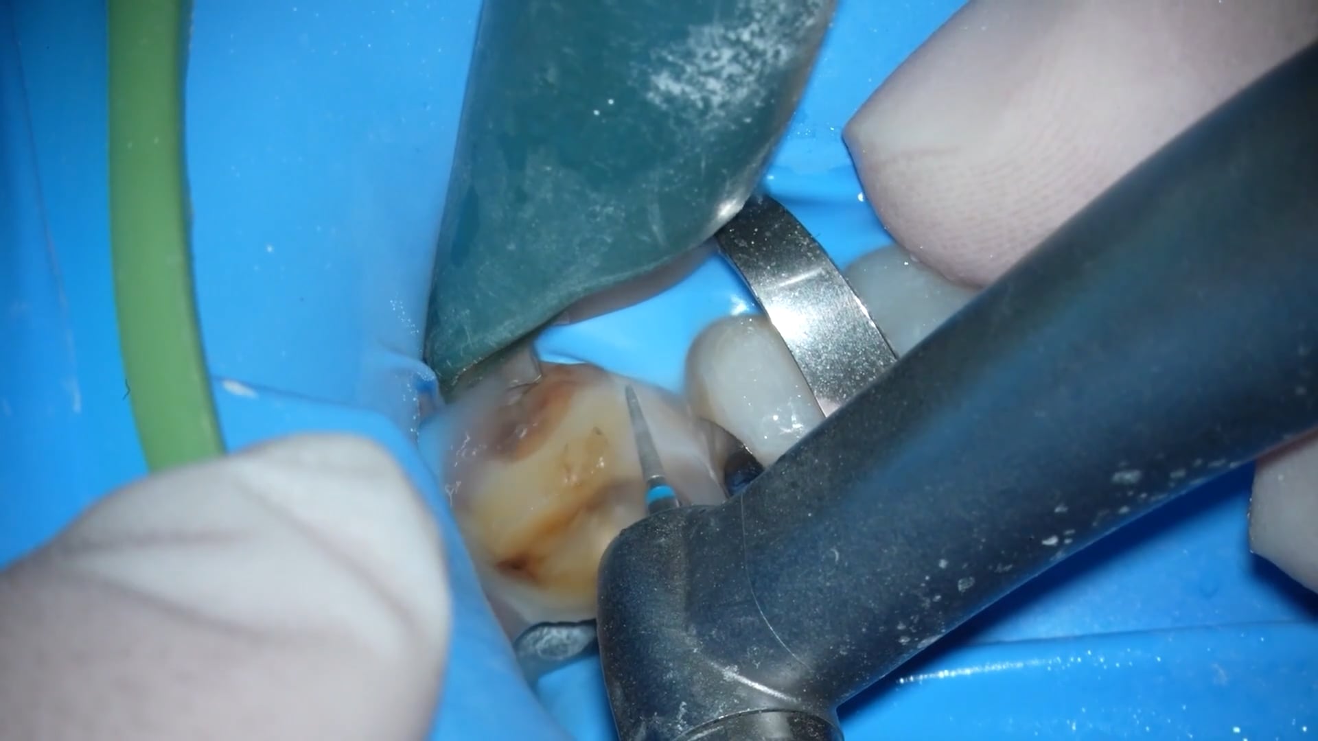 【GPB_crown_llp_050】う蝕除去+形成②