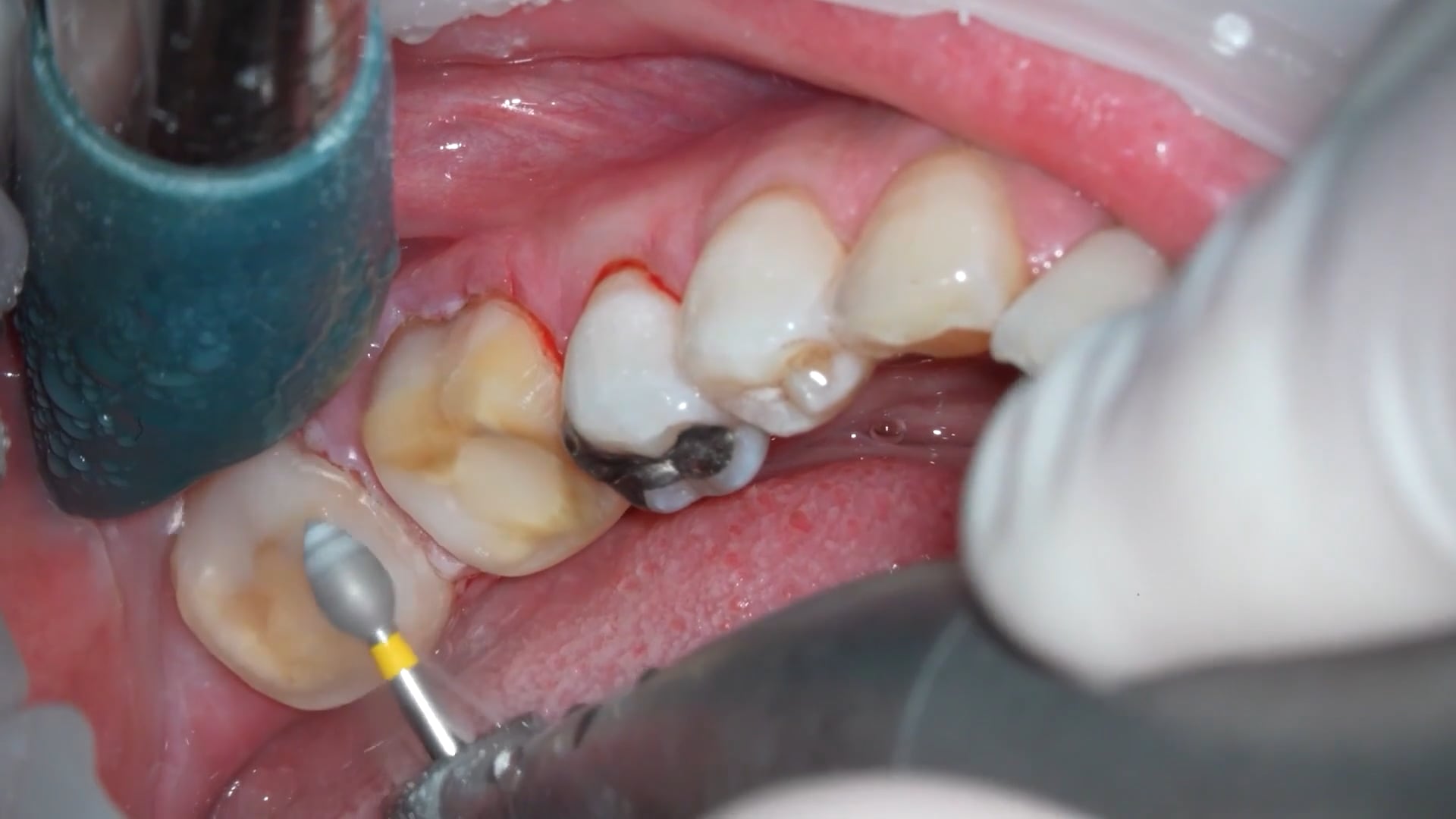 【GPB_crown_llp_070】支台歯形成①