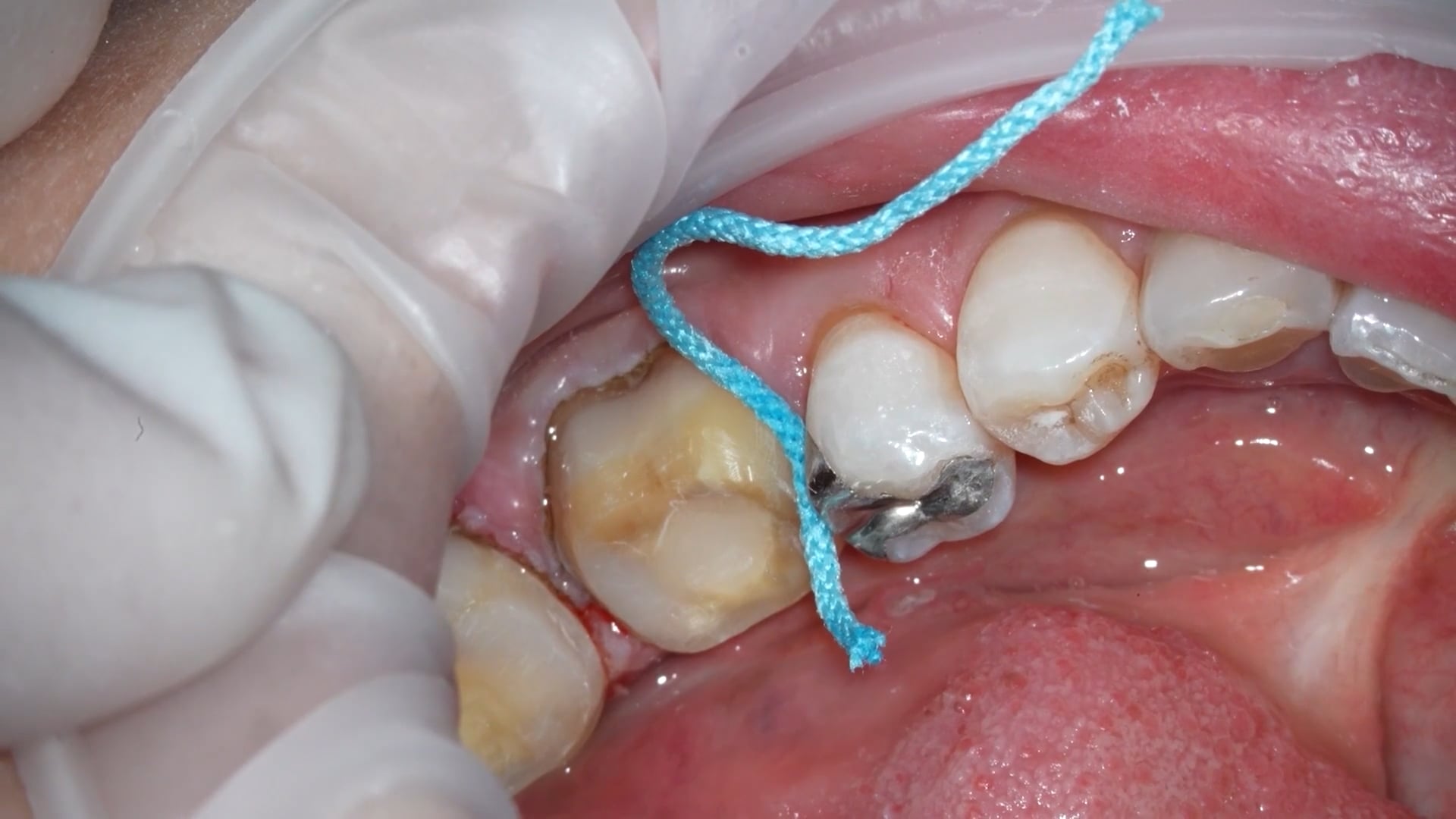 【GPB_crown_llp_080】支台歯形成②