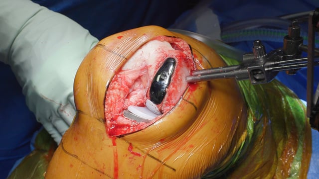 Mako Unicompartmental Knee Arthroplasty (UKA) Surgical Technique