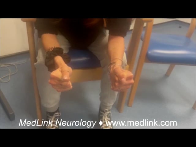 Hand grip myotonia