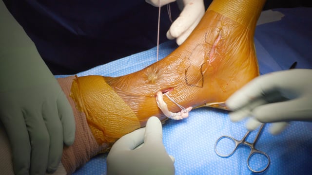 Posterior Tibial Tendon Transfer and Achilles Tendon Lengthening for Foot Drop