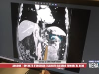 Ancona - Operato d’urgenza e salvato da raro tumore al rene