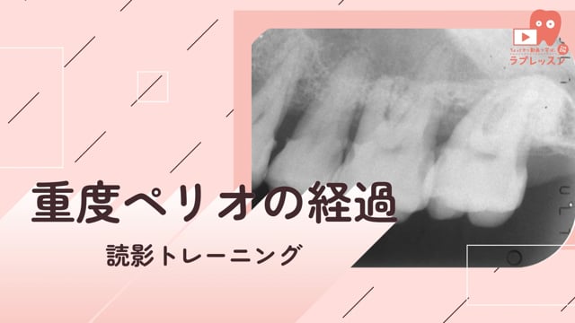 03.重度ペリオの経過