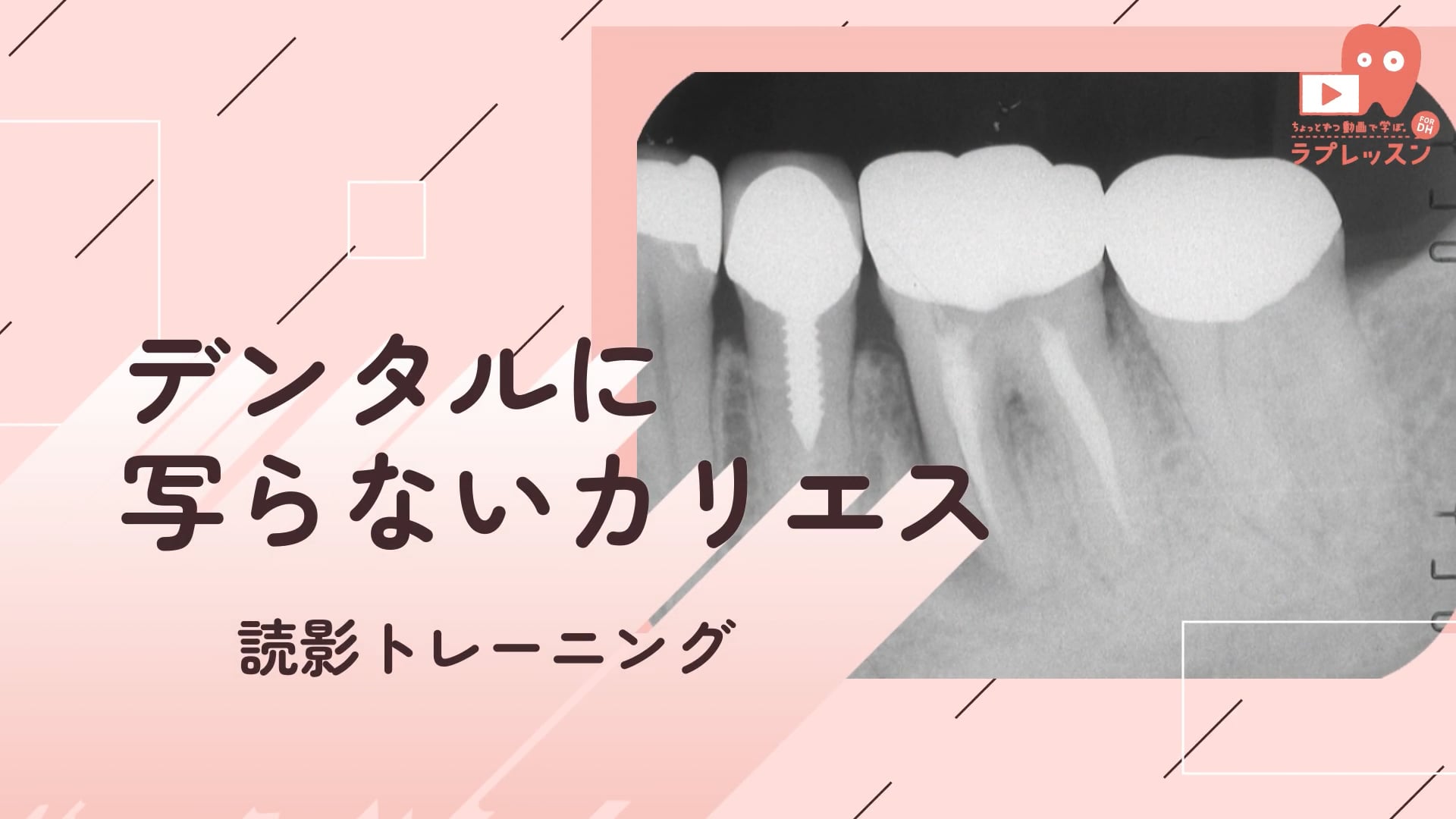  02.デンタルに写らないカリエス