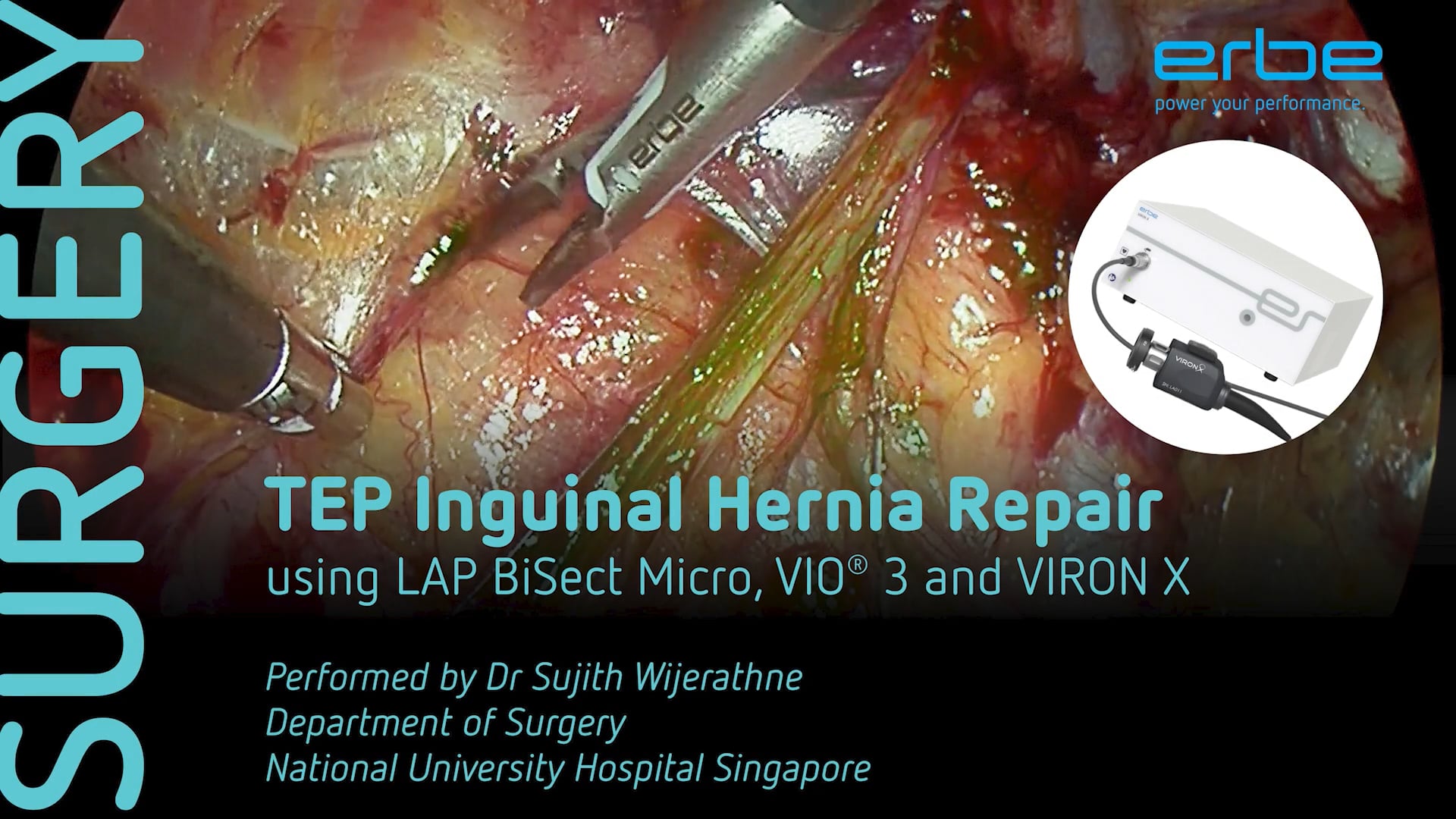 TEP inguinal hernia repair using LAP BiSect Micro, VIO® 3 and VIRON X