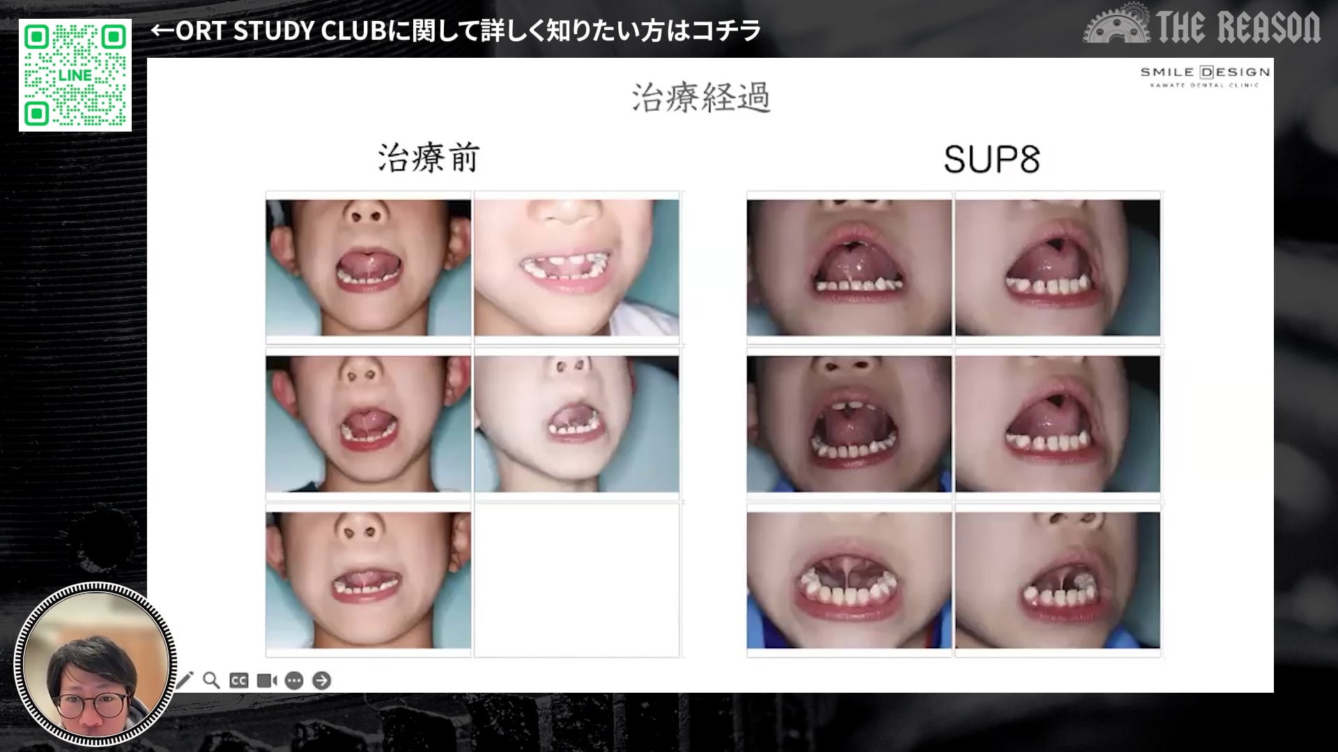 第35回 7歳男児の重度小児矯正症例：アレルギーと機能不全への原因介入