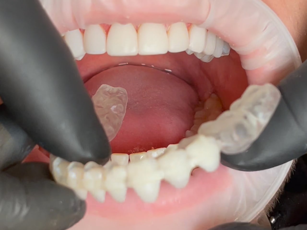 Process Video 1 Composite Veneer