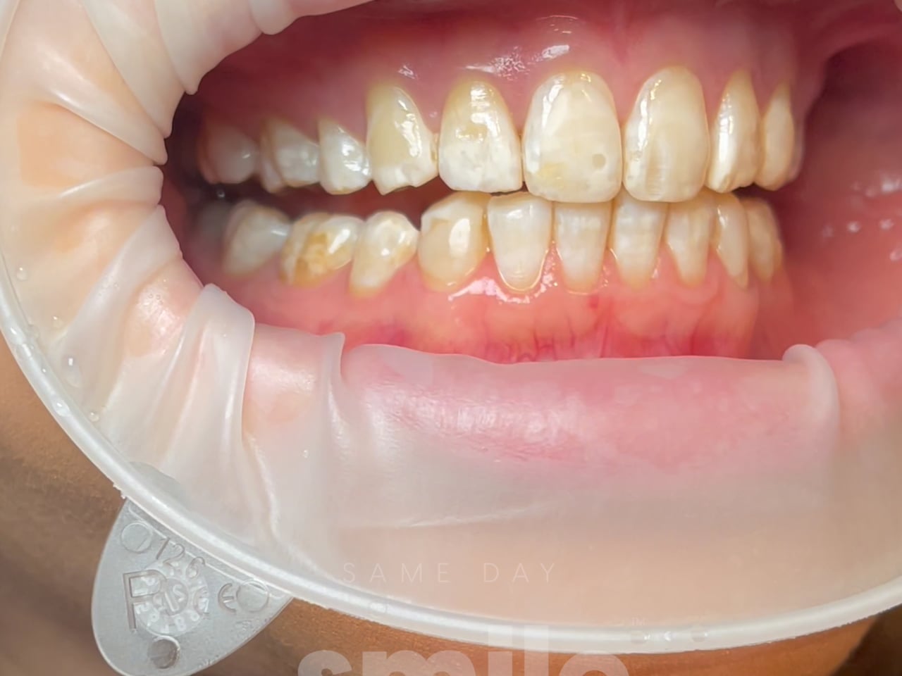 Process Video 2 Porcelain Veneer