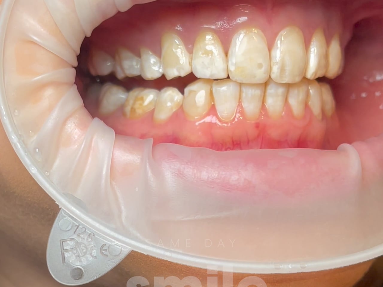 Process Video 3 Porcelain Veneers