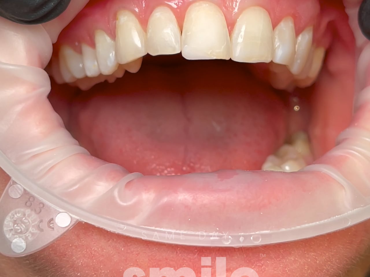 Process Video 5 Composite Veneers