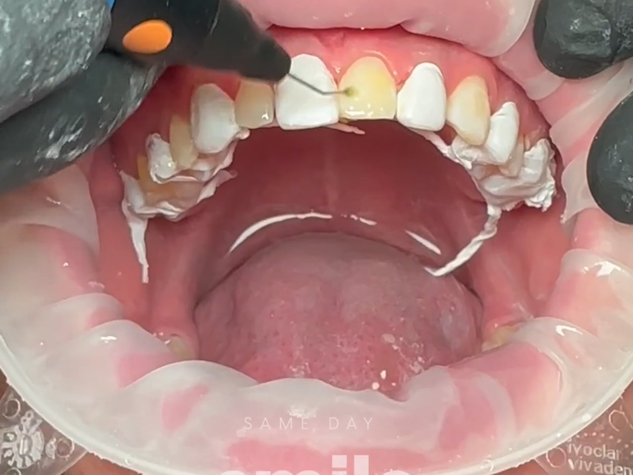 Process Video 4 Composite Veneers