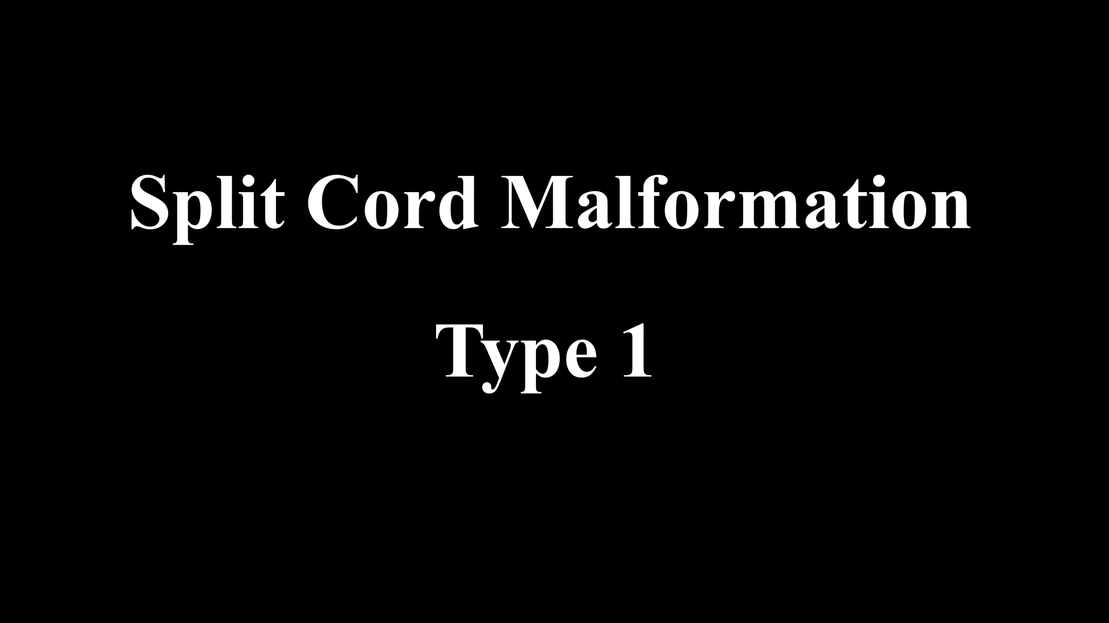 Split Cord Malformation