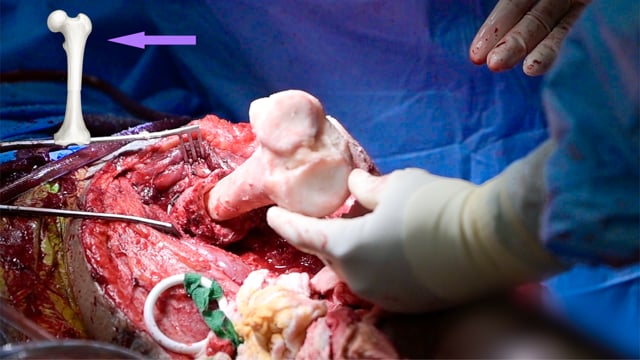 Conversion Distal Femur Replacement with Telescoping Tibial Allograft