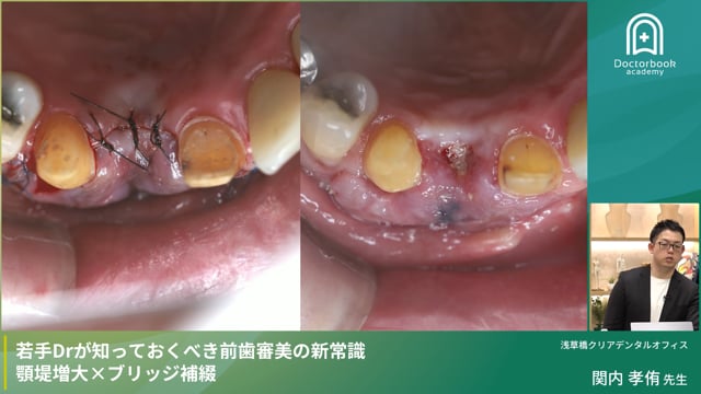若手Drが知っておくべき前歯審美の新常識 顎堤増大×ブリッジ補綴