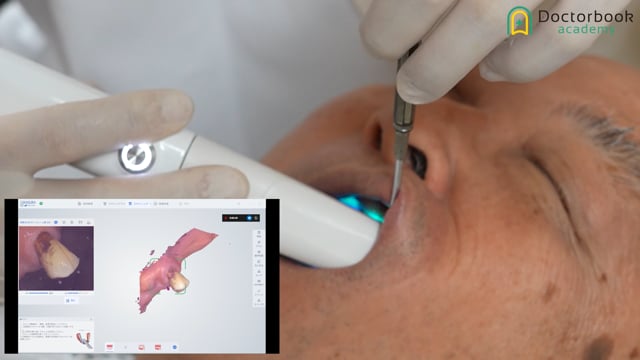 Day 1：村岡先生の最後の部分床義歯｜口腔内スキャナー（IOS）で上下顎印象採得