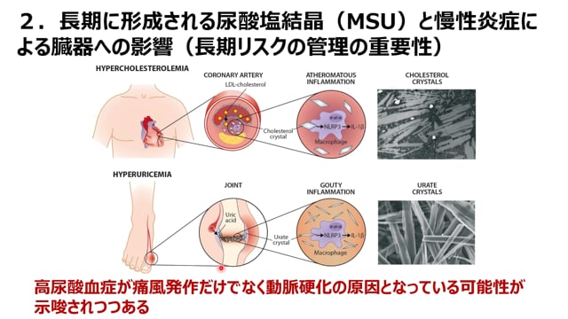 ⑨尿酸塩結晶と慢性炎症による臓器への影響