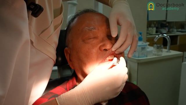 Day 4：村岡先生の最後の部分床義歯｜義歯セットと最終調整