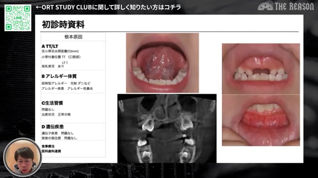 第36回 アレルギー性鼻炎から始まる小児不正咬合 7歳男児の原因療法アプローチ