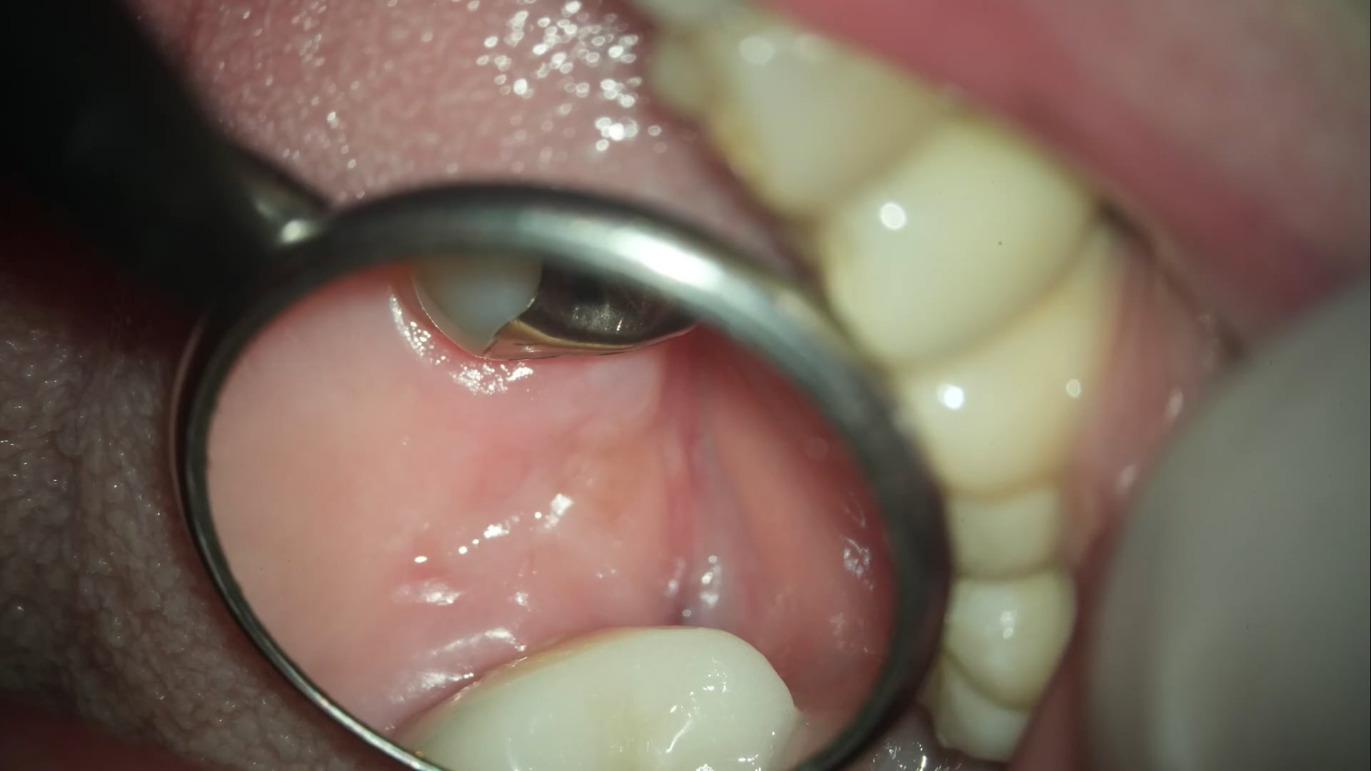 【GPB_implant_up_010】術前