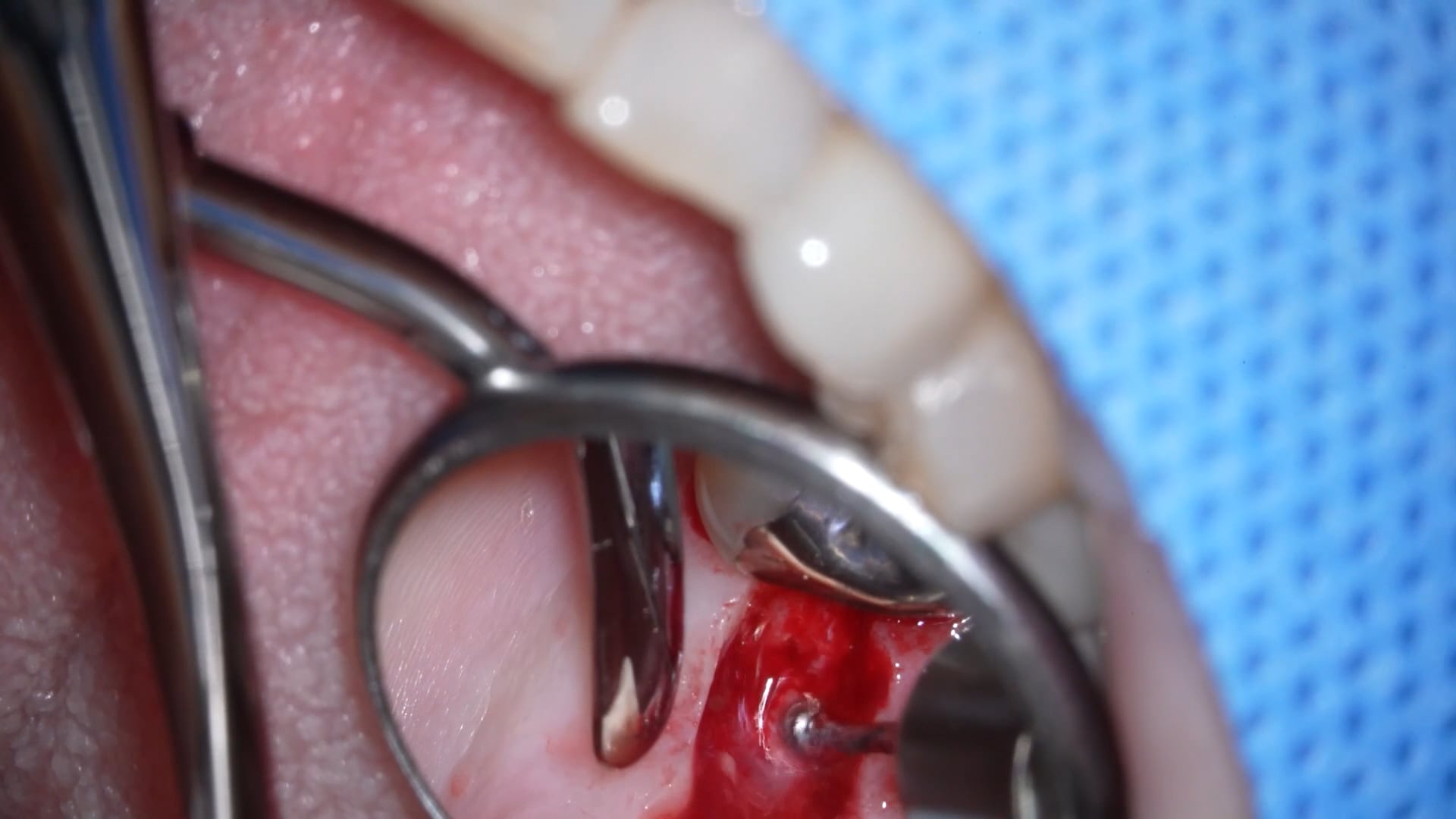 【GPB_implant_up_040】ディンプル形成、方向指示棒の挿入