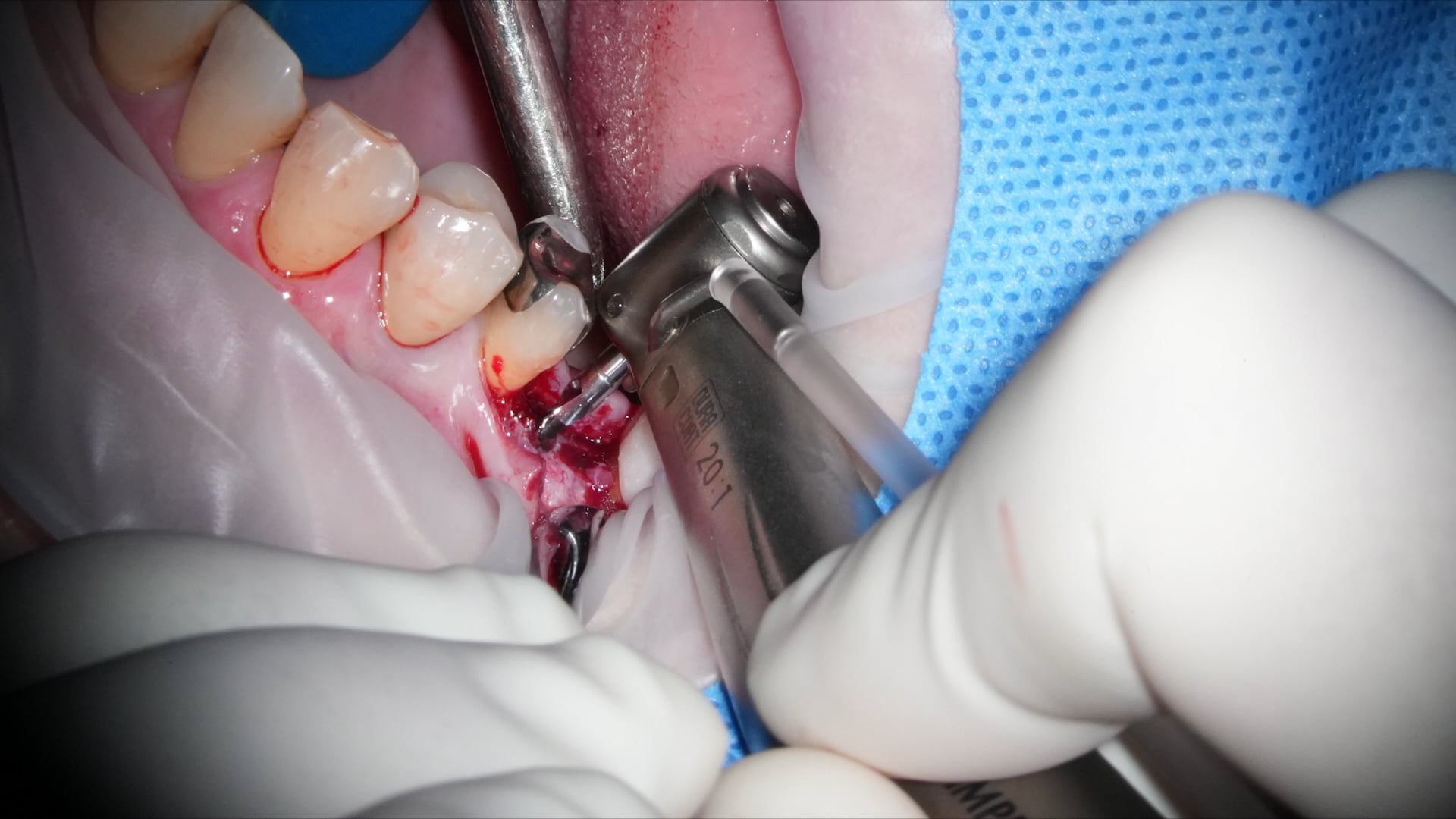 【GPB_implant_up_050】インプラント埋入
