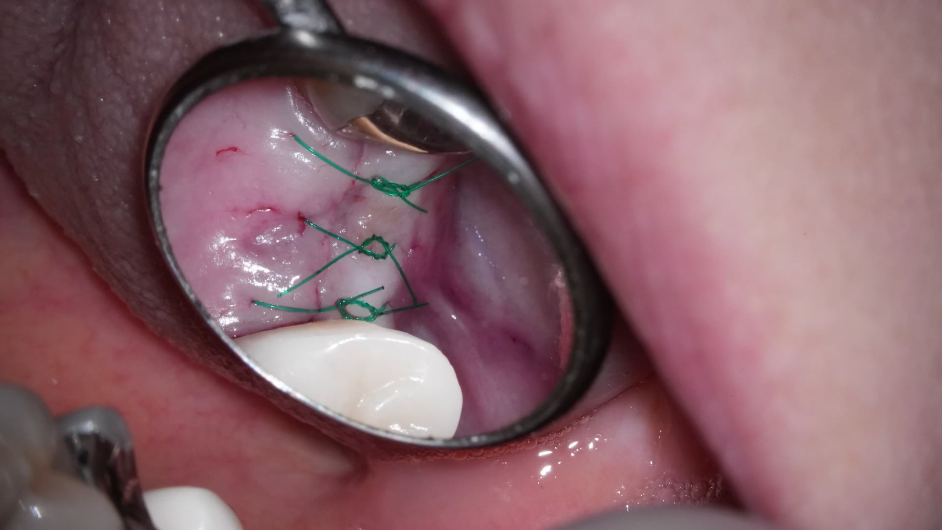 【GPB_implant_up_070】術後
