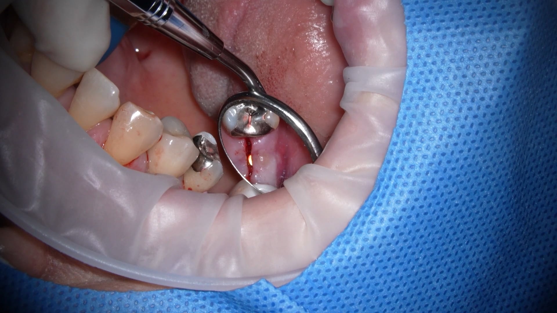 【GPB_implant_up_060】縫合