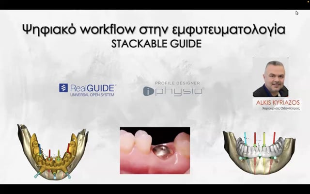 Ψηφιακό workflow στην Εμφυτευματολογία: Realguide - Stackable guides - Iphysio system.