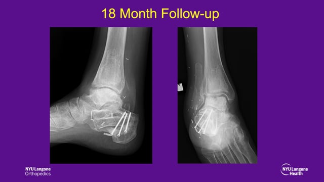 Subtotal Reconstruction of the Calcaneus with combined Pedicled Fibular Flap and Structural Allograft