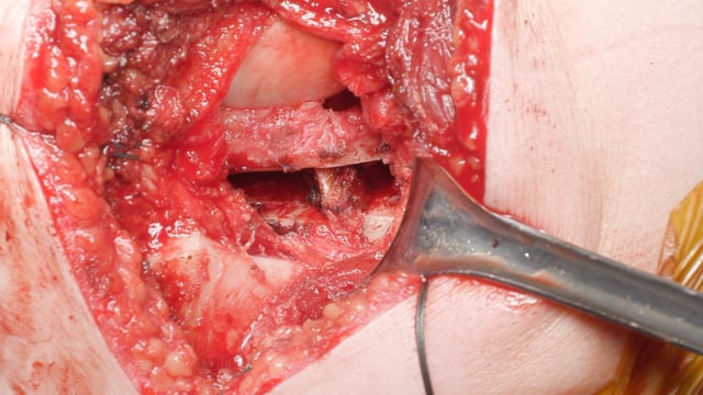 Combined Opening Wedge Glenoid Osteotomy and Posterior Bone Block for Glenoid Dysplasia with Posterior Instability