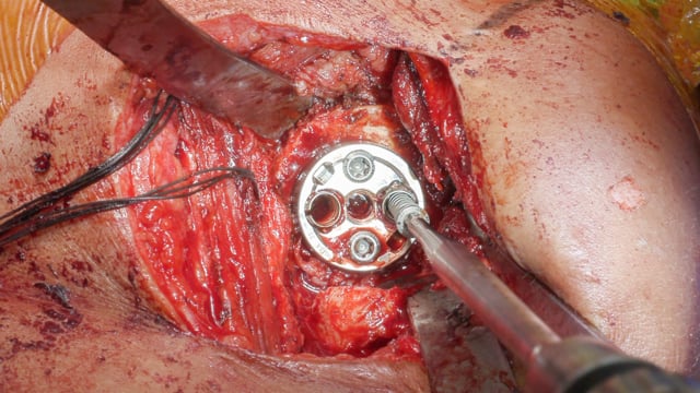 Conversion to Reverse Total Shoulder Arthroplasty Following Glenoid Allograft Reconstruction for Chondrosarcoma